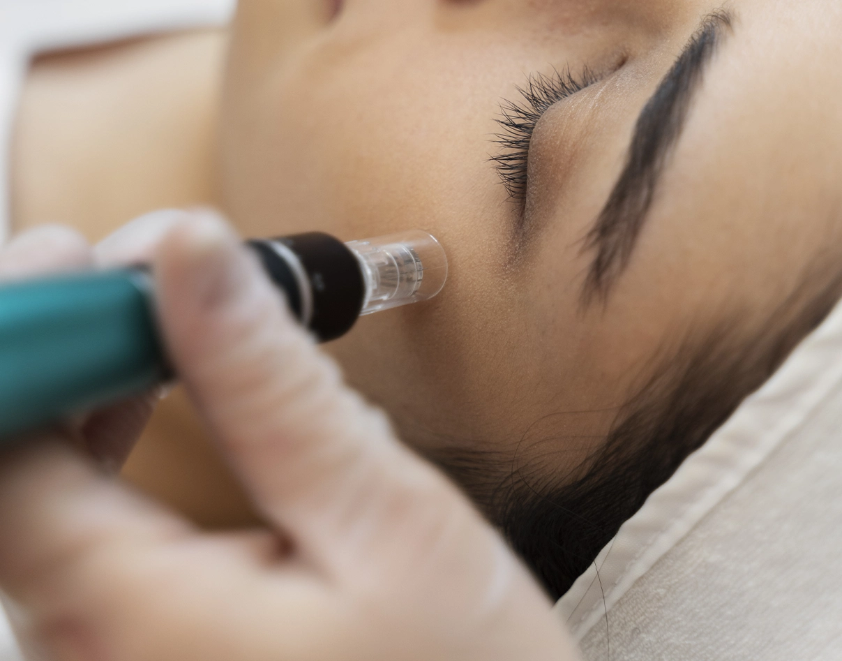 Microneedling con péptidos